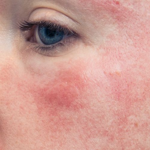 SENSITIVE SKIN